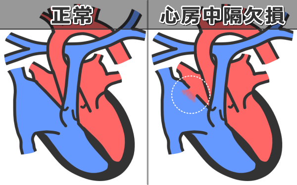 心房中隔欠損症の病態～心房と心房の間に卵円孔と呼ばれる先天的な通過孔が見られる