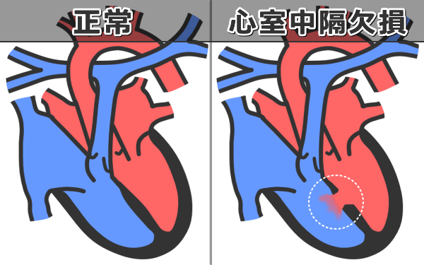 犬の心室中隔欠損症～心室間の壁に穴が空き、左心室からの血液が右心室に乱入している