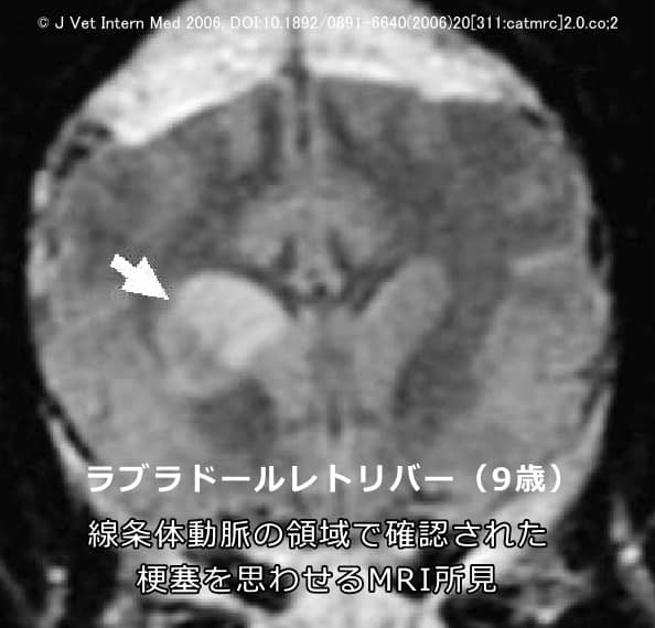 尾状核頭部にある線条体動脈の領域で見られた終脳梗塞所見