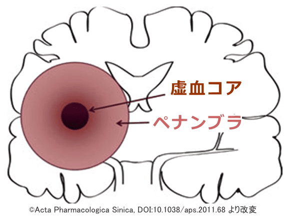 脳卒中後における虚血コアとペナンブラの模式図