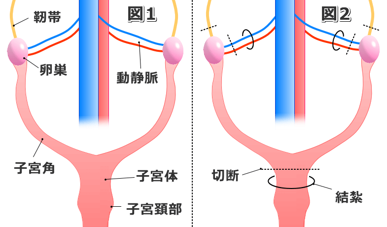 メス犬の避妊（子宮卵巣切除）手術における結紮部と切断部の図解