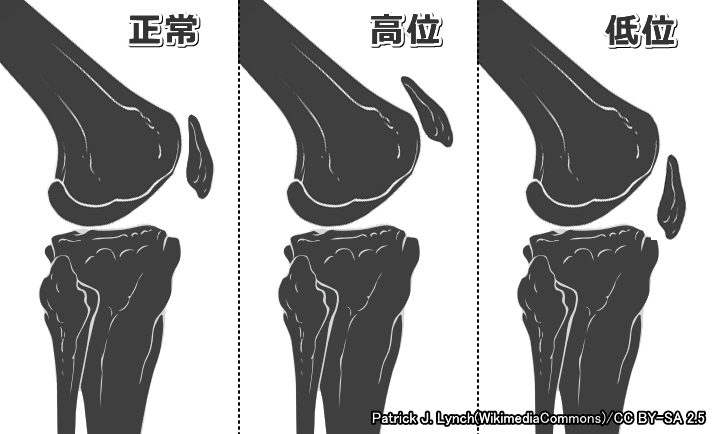 正常な膝蓋骨と膝蓋骨高位（Patella alta）および膝蓋骨低位（Patella baja）の比較図