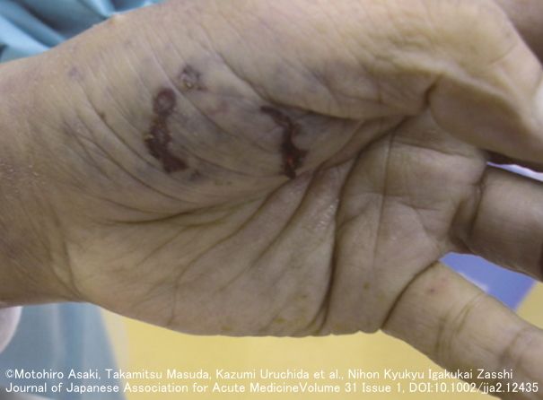 カプノサイトファーガ・カニモルサスの感染経路となった左手母指球の犬による噛み傷