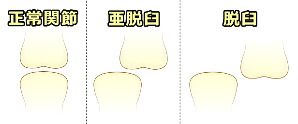 正常関節と亜脱臼、脱臼関節の違い模式図