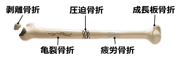 骨折の種類一覧図