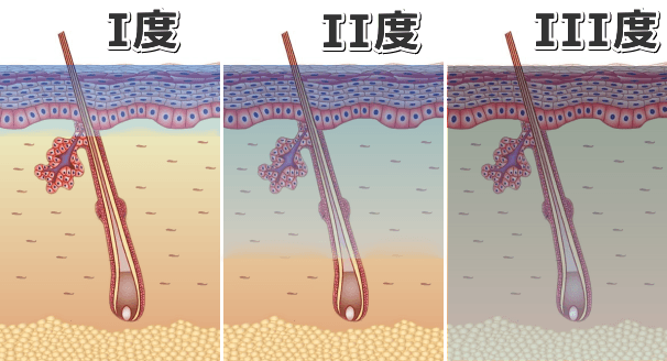 深度によって分類したときの凍傷