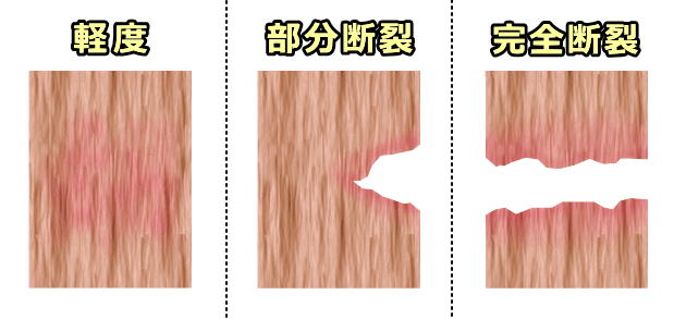 靭帯損傷（捻挫）の3段階～軽度捻挫・部分断裂・完全断裂