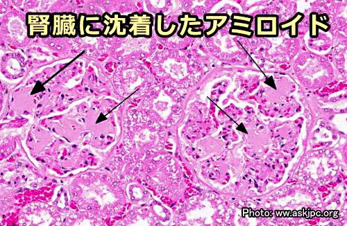 腎臓の細胞間に沈着したアミロイド塊