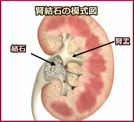 腎盂内に発生した腎結石の模式図