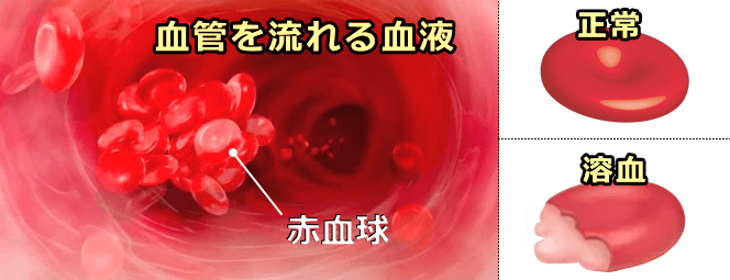 血管中を流れる血液と正常赤血球、溶血赤血球の模式図