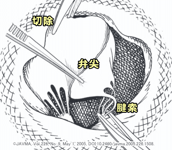僧帽弁置換術では変性した腱索や弁尖を切除してしまう