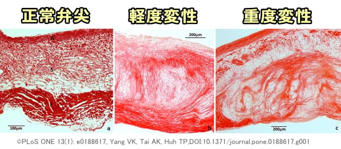 正常な僧帽弁と粘液腫様病変をもった僧帽弁の組織学的所見