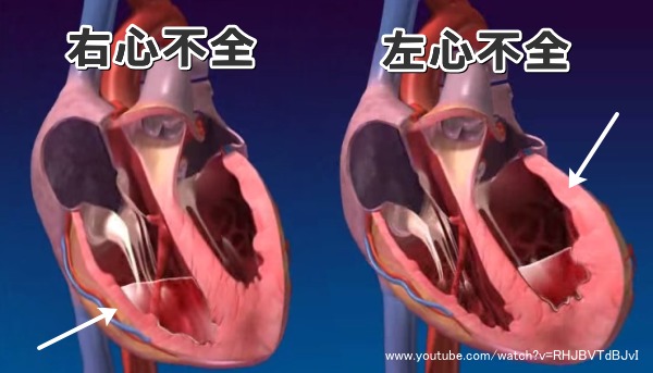 右心系のうっ血性心不全と、左心系のうっ血性心不全・模式図