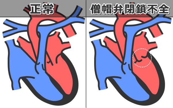 僧帽弁閉鎖不全の病態～僧帽弁の機能不全で大動脈にいくはずの血液が左心房に逆流している