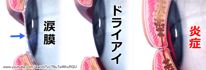 犬の眼球表面における涙膜とドライアイの比較図