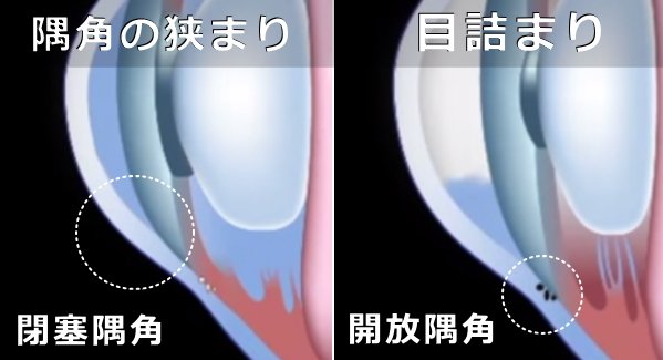 緑内障の発症パターン～開放隅角と閉塞隅角