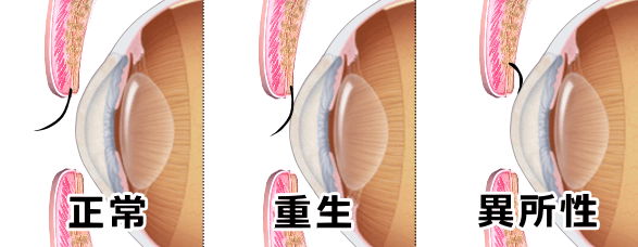 坂まつ毛の種類～正常・重生・異所性