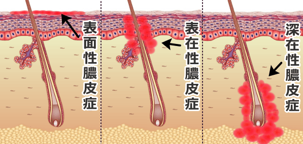 発症部位によって分類される膿皮症