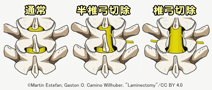 椎弓切除術と半椎弓切除術の模式図