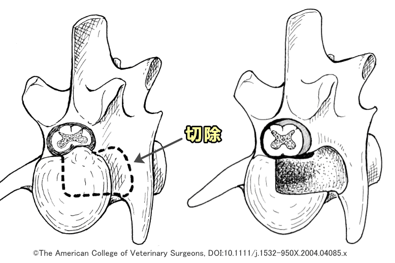 椎体切除術の模式図