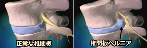 正常な椎間板とヘルニアを生じた椎間板の比較図