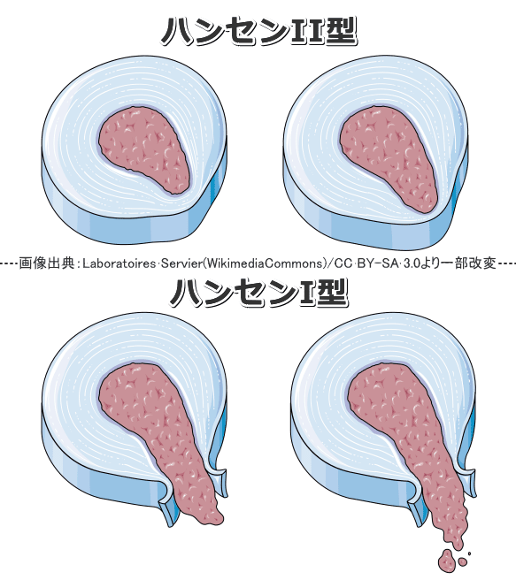 ハンセンによる椎間板ヘルニアの形状的分類法