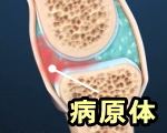 感染性関節炎の模式図