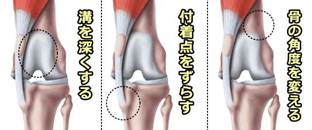 膝蓋骨脱臼に対する外科的なアプローチ法