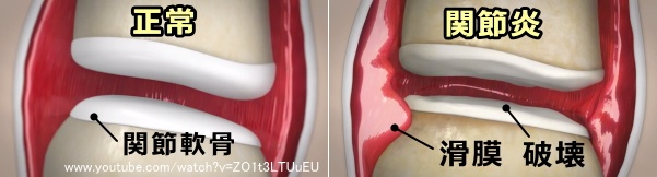 正常な関節と免疫性関節炎を起こした関節の比較模式図