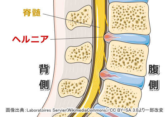 椎間板ヘルニアの病態生理図解