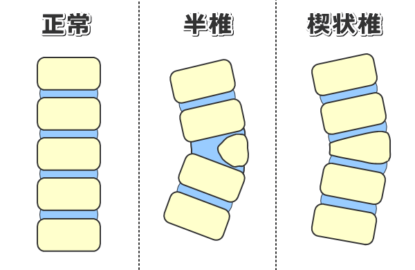 犬の脊椎奇形～正常・半椎・楔状椎