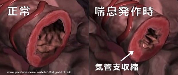 正常時と喘息発作時の犬の気管支比較図