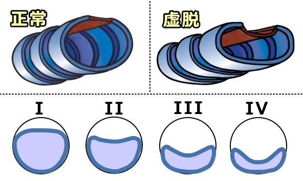 犬の気管虚脱の重症度（I～IV度）