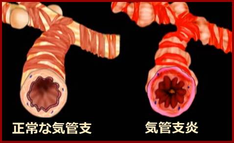 気管支炎の模式図