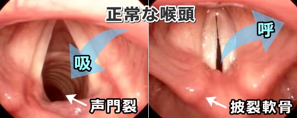 正常な喉頭の声門~吸気で開き呼気で閉じる