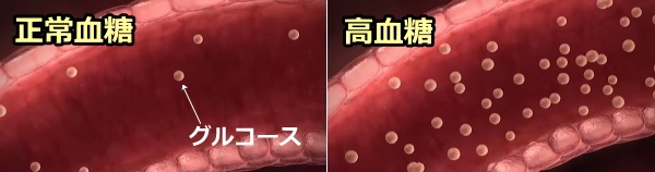 正常な血糖と高血糖の比較模式図