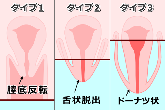 犬の膣脱3タイプ