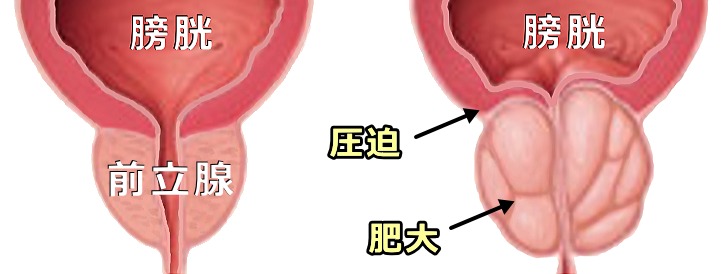 正常な前立腺と肥大した前立腺の比較模式図