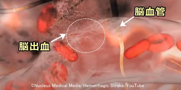 脳出血の模式図