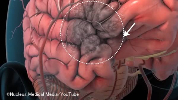 脳梗塞の模式図