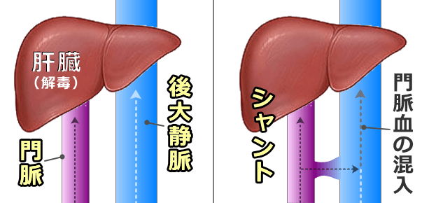 肝性脳症の原因として多い門脈体静脈シャントの模式図