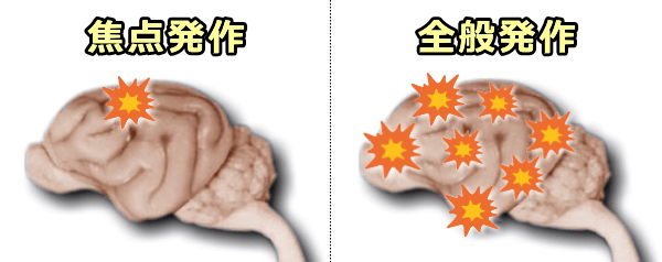 犬のてんかんにおける焦点発作と全般発作の模式図