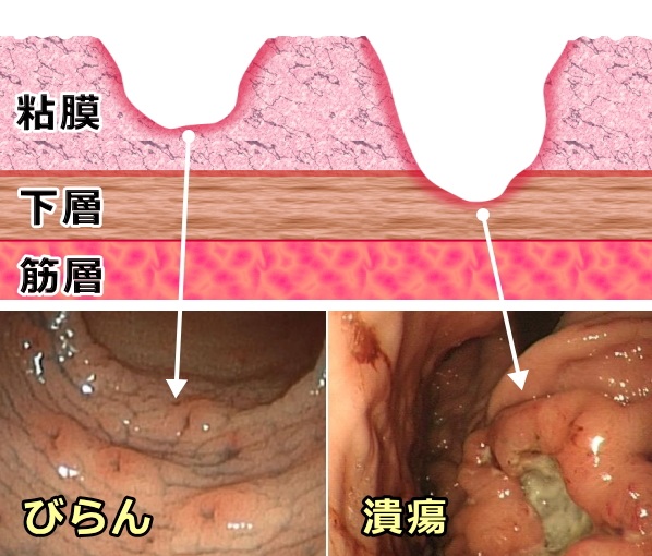 びらんと潰瘍の違い模式図