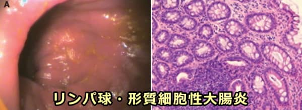リンパ球・形質細胞性腸炎の組織学的所見