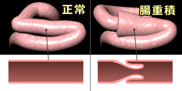 正常な腸管の縦断面図、および重積を起こした腸管の縦断面図