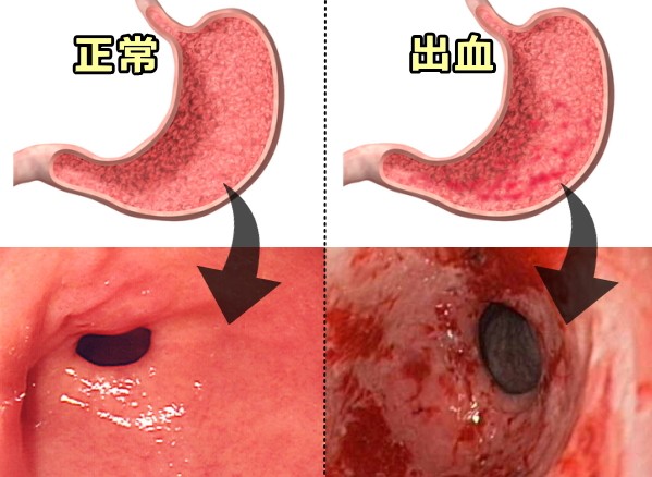 健康な胃と出血を起こした胃の肉眼的、および内視鏡的外観比較写真