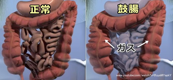 正常な腸と鼓腸を起こした腸の比較模式図