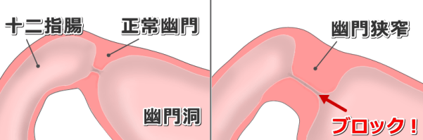 正常な幽門と狭窄を起こした幽門の比較模式図