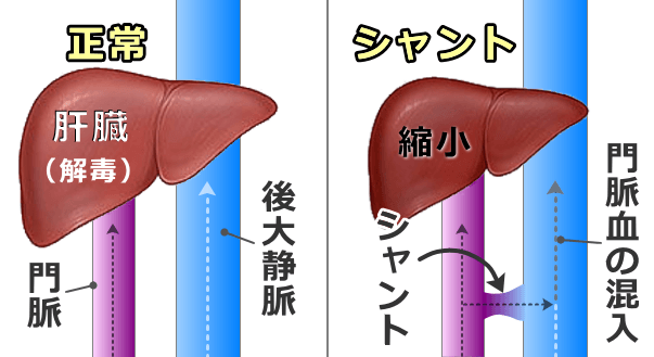 犬の門脈体循環シャント模式図～正常な血液の流れとシャントにおける異常循環