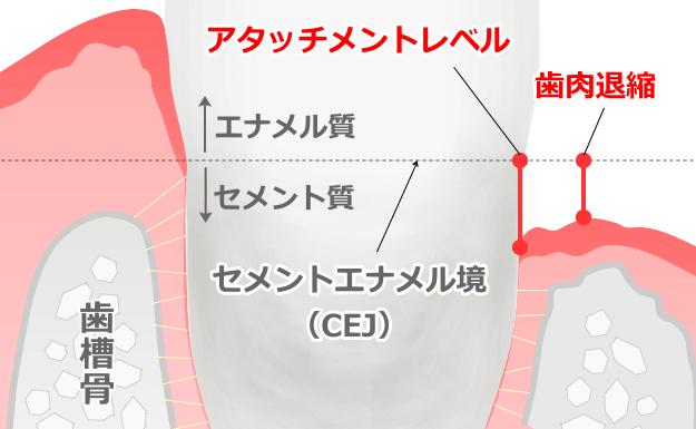 歯周病の進行度を判定するときの歯肉退縮とアタッチメントレベルの模式図